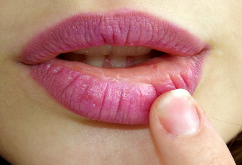 Câncer de pele pode atingir os lábios?