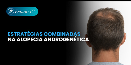 Estratégias Combinadas na Alopecia Androgenética