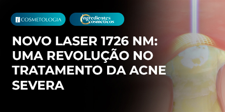 Novo laser 1726 nm: uma revolução no tratamento da acne severa
