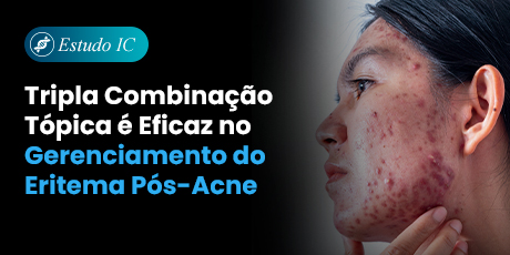 Tripla Combinação Tópica é Eficaz no Gerenciamento do Eritema Pós-Acne