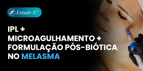 IPL + Microagulhamento + formulação pós-biótica no melasma