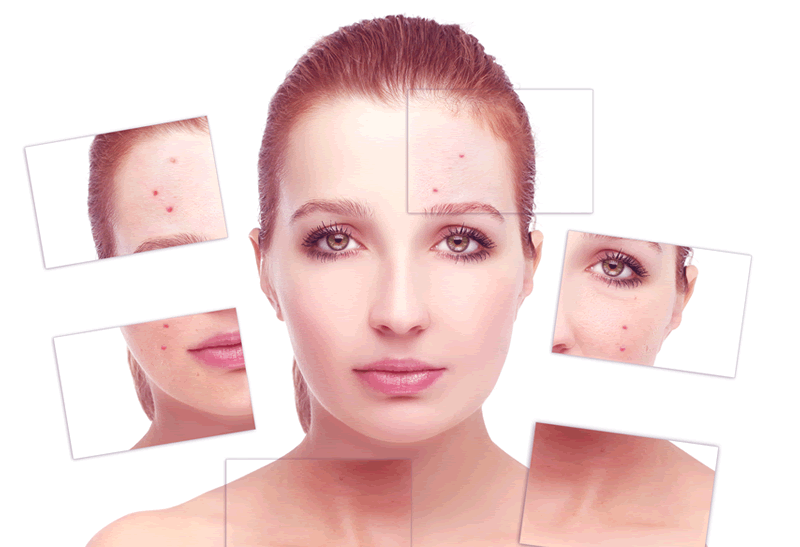 Adição de Ácido Salicílico ao Tratamento com Clindamicina e Peróxido de Benzoíla Potencializa a Redução dos Comedões na Acne