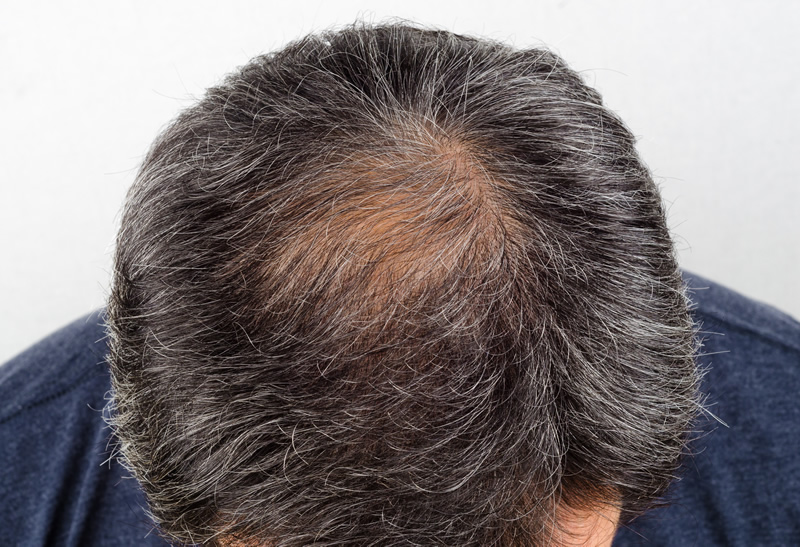 Produto Capilar Aumenta a Espessura e a Quantidade de Fios na Alopecia Androgenética