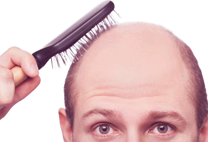 Óleo de Rosmarinus é Tão Eficaz Quanto Minoxidil para Tratamento da Alopecia Androgenética