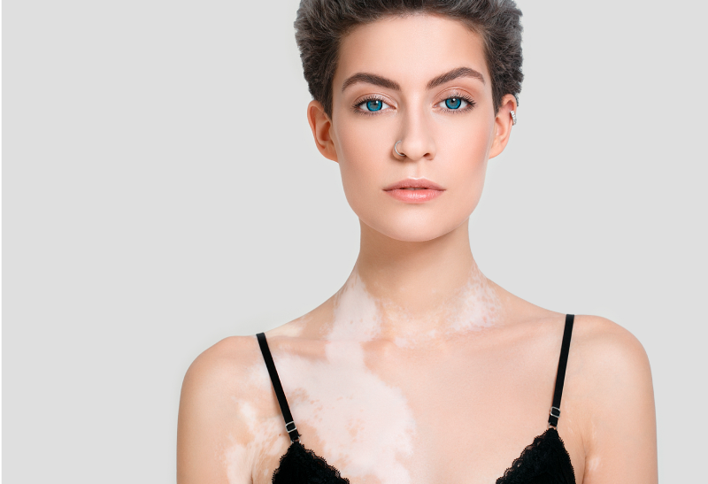 Cosméticos de Alta Cobertura e Fixação no Tratamento do Vitiligo