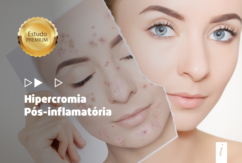 Tratamento de hipercromia pós-inflamatória com diferentes formulações clareadoras